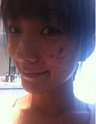 额头缝针后可以吃瓜吗,瓜果美食的适宜选择指南